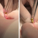 Шымкенттік дәрігерлер үш жасар баланың асқазанынан 16 магнит алып шықты