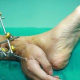 Қытайлық дәрігерлер науқастың жұлынып кеткен қолын оның аяғына тігіп, өмірін сақтап қалды