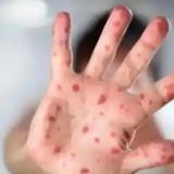 Ақтөбеде балалар арасында қызылша жұқтырғандар көбейді