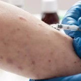 Екі мыңға жуық адам: Денсаулық сақтау министрлігі қызылшаға байланысты дабыл қақты