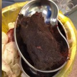 Түркістанда 15 жастағы қыздың асқазанынан 1 келідей шаш шықты