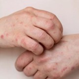 Қызылша құтырып барады. Ақтөбеде ауру жұқтырғандар үш есе көбейді