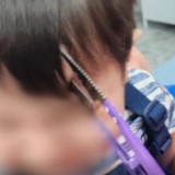 Алматылық дәрігерлер маңдайына қайшы қадалған баланы құтқарды