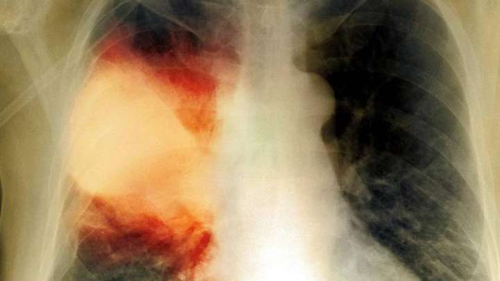 Қазақстанда пневмония өршіп барады