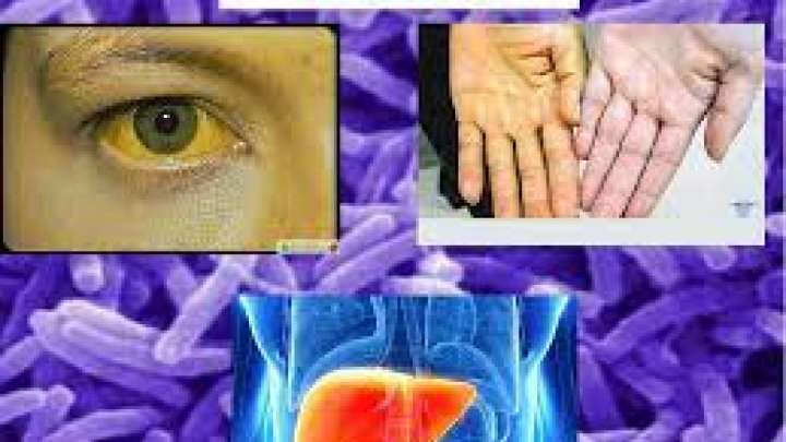 Қазақстанда гепатит А ауруына шалдыққандар көбейген