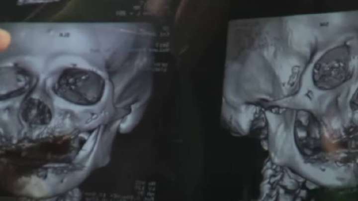 Алматыда 11 тісіне имплантация жасатқан әйелдің сүйегі шытынап кеткен