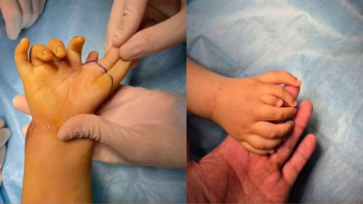 Алматыда 8 саусақпен туған балаға бірегей ота жасалды