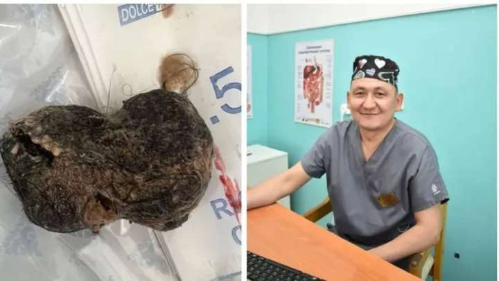 Жамбылда қыз баланың асқазанынан бір уыс шаш шықты