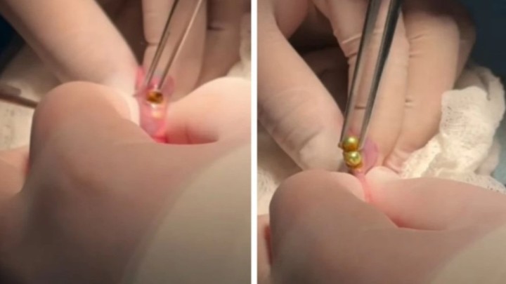 Шымкенттік дәрігерлер үш жасар баланың асқазанынан 16 магнит алып шықты