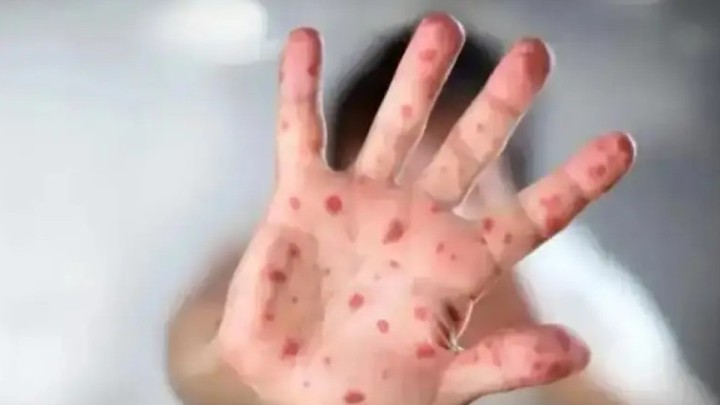 Ақтөбеде балалар арасында қызылша жұқтырғандар көбейді