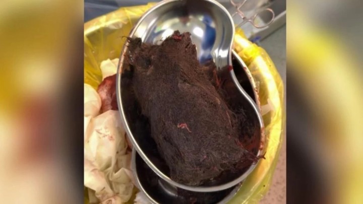 Түркістанда 15 жастағы қыздың асқазанынан 1 келідей шаш шықты