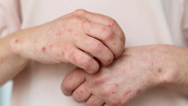 Қызылша құтырып барады. Ақтөбеде ауру жұқтырғандар үш есе көбейді