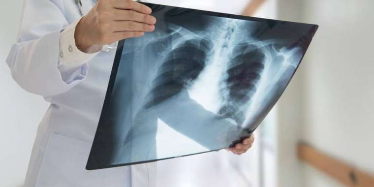 Қазақстанда 150 мың науқас коронавирус пен пневмониядан емделді