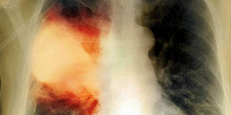 Қазақстанда пневмония өршіп барады