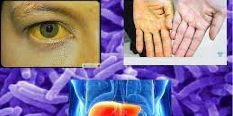 Қазақстанда гепатит А ауруына шалдыққандар көбейген