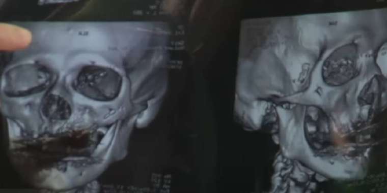 Алматыда 11 тісіне имплантация жасатқан әйелдің сүйегі шытынап кеткен