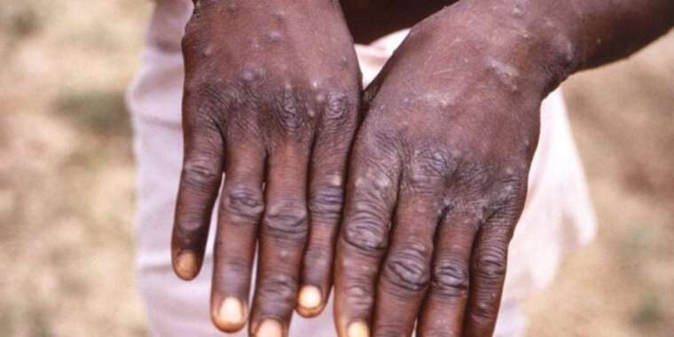 Маймыл шешегінен 50 адам қайтыс болды