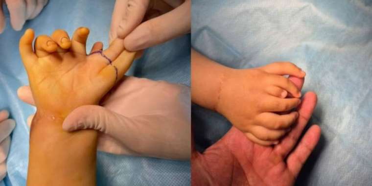 Алматыда 8 саусақпен туған балаға бірегей ота жасалды