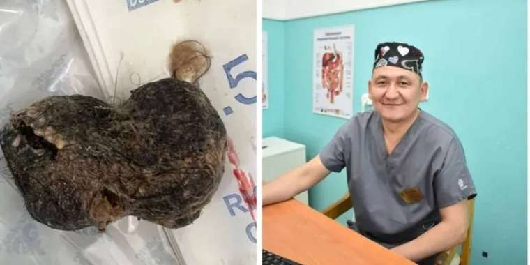 Жамбылда қыз баланың асқазанынан бір уыс шаш шықты