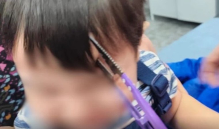 Алматылық дәрігерлер маңдайына қайшы қадалған баланы құтқарды