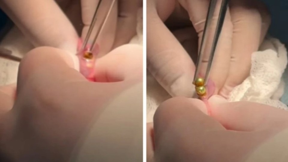 Шымкенттік дәрігерлер үш жасар баланың асқазанынан 16 магнит алып шықты