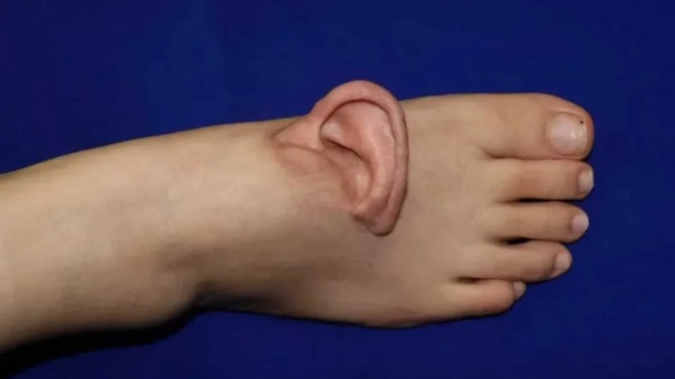 Қытайлық дәрігерлер науқастың құлағын оның аяғына тігіп, өмірін сақтап қалды