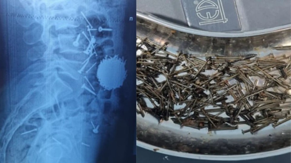 29 жастағы ер адам стресске түсіп кетіп, бірнеше шегені жұтып қойды (ФОТО)