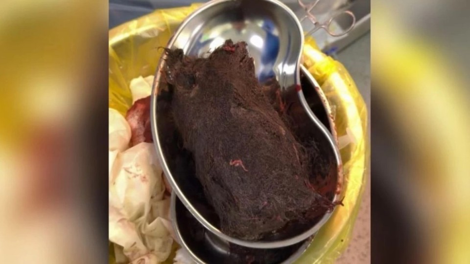 Түркістанда 15 жастағы қыздың асқазанынан 1 келідей шаш шықты